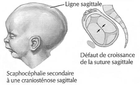 Scaphocéphalie