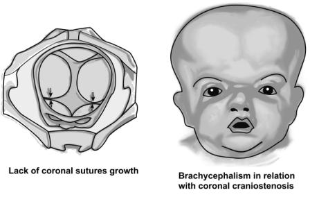 Brachycephalism