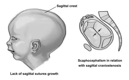 Scaphocephalism